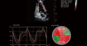 Myocardium Quantitative Analysis (MQA)